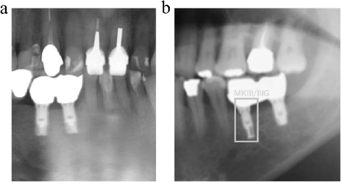 Figure 6. Sample images of misdetected implants. a Both implants could not be detected because of the shadow of the spina. b Left implant was detected correctly as MK III/IIIG, but the right implant was not detected because of an unclear image