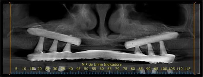 Figure 6. Tomographic scan of the follow-up