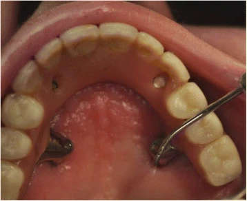 Figure 6. Zygomatic implant probing using a WHO periodontal probe