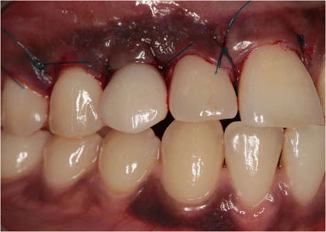Figure 7. Clinical view immediately after placement of the provisional implant crown