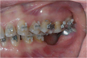 Figure 7. Ortodontic bracket placement: right side view