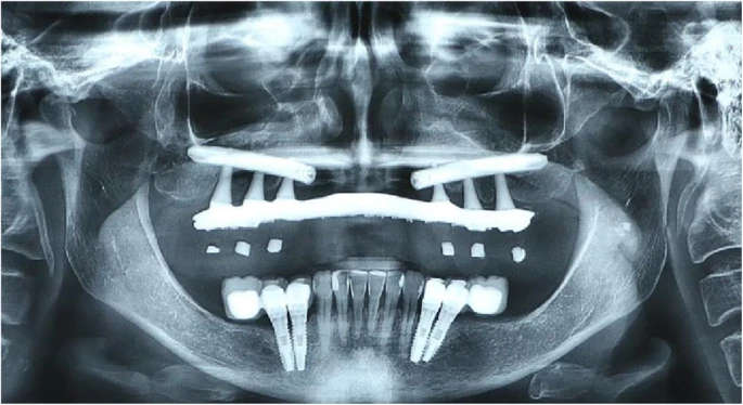 Figure 7. Panoramic radiography of the follow-up