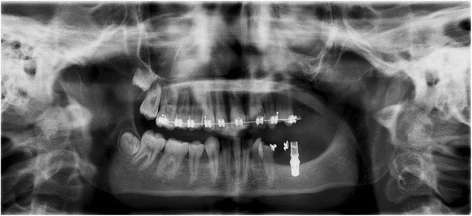 Figure 7. Patient 2—post-operative orthopantomogram (OPT) at age of 13. Situation 10 months after implant placement. Three months after starting the orthodontic treatment, the 34 is already erected