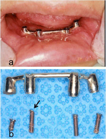 Figure 7. a Intraoral photograph. b Gold Dolder bar and screws; marked wear of a prosthetic screw (arrow)