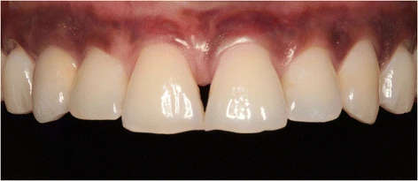 Figure 8. Clinical view showing optimal esthetics around the screw-retained definitive all-ceramic crown