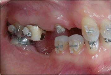 Figure 8. Orthodontic bracket placement: left side view