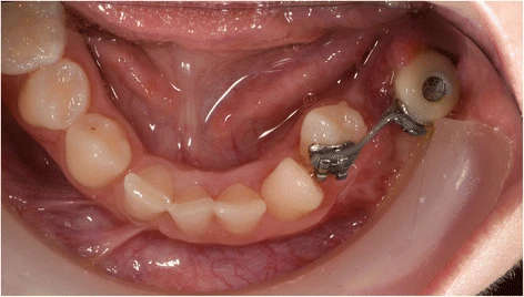 Figure 8. Patient 2—intra-oral situation during orthodontic treatment at the age of 14. A temporary crown with bracket is fixed on the dental implant. Eight months after start of orthodontic treatment, the 34 is already close to the planned end position
