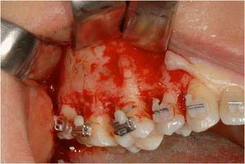 Figure 9. A microsurgical corticotomy was mandatory to assist orthodontic tipping and intrusion of elements 16 and 17