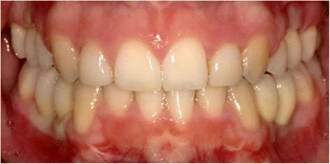 Figure 9. Patient 1—prosthodontic end result 5 months after implant placement