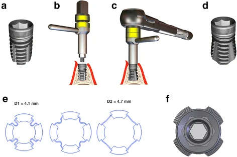 Figure 1. a Closed short expandable dental implant (4.1 × 7 mm). The implant-abutment connection is characterised by an internal hexagon for rotation stability, combining the advantages of conical and parallel surfaces to reduce microgaps and micromovement. The microthread concept and platform switching concept are implemented in the implant shoulder to reduce periimplant bone strain. b Manual fixation of the expansion tool. Take note of the distance between both yellow rings. c Completion of the expansion process using the ratchet. Take note of the contact between both yellow rings. d Opened short expandable dental implant (4.1 × 7 mm). The expanded implant provides an increased bone-to-implant interface (pyramid shape) in the apical portion. e Cross-section view of the implant apex. The apical expansion process is characterised by the unfolding of four wings, which are connected by four foils. D1: diameter of the closed implant. D2: diameter of the opened implant. f Top view of the expanded implant. The expanded implant (4.1-mm diameter) displays an apical diameter of 4.7 mm and length of the edge (base) of 4.4 mm