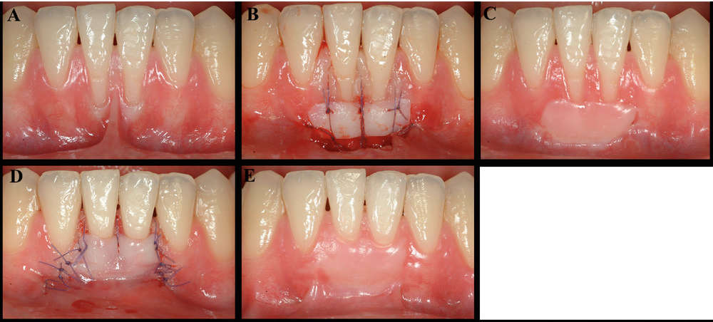 Graft gusi bebas pada gigi seri sentral bawah