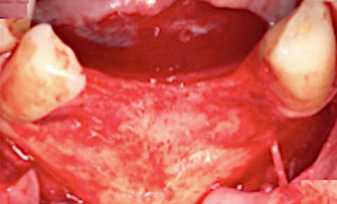 Alveolar atrophy