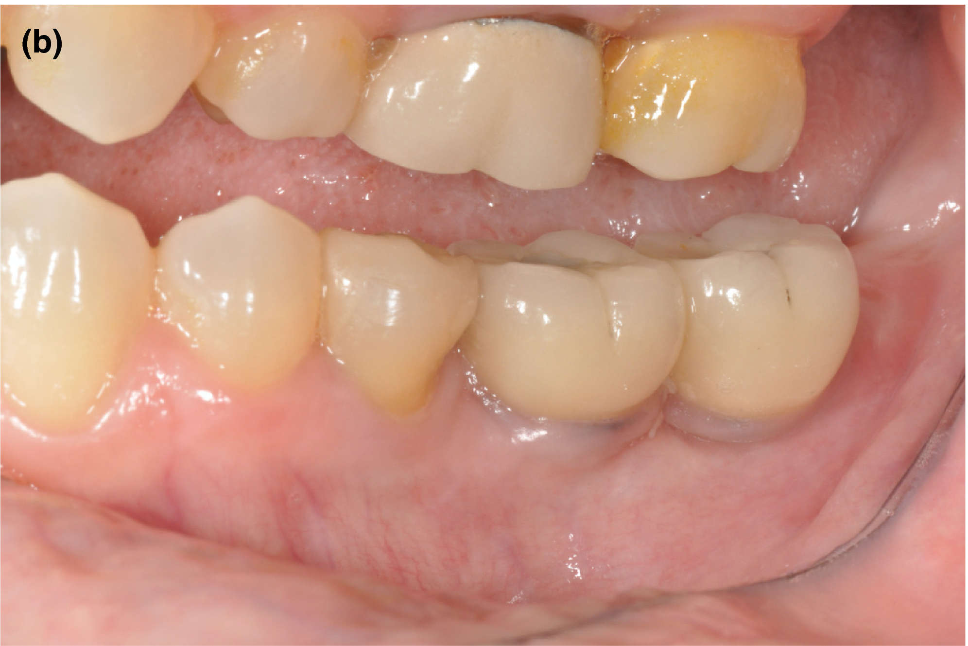 figure 1b five year follow‐up clinical photograph of patient with two 6 mm implants