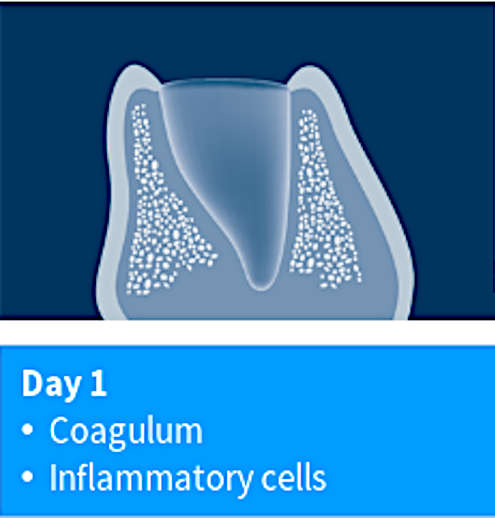 Day 1: Coagulum & inflammatory cells