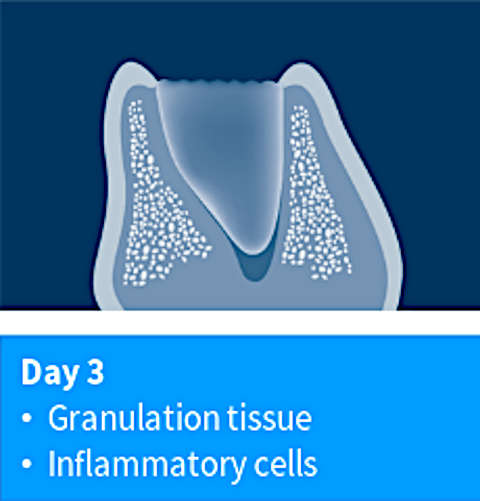 Day 3: granulation tissue & inflammatory cells