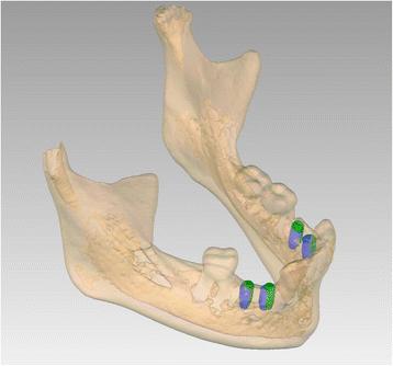 Fig. 10. Patient 1—post-operative evaluation of placement accuracy of the implants in the mandible. Green is the planned position; blue is the actual position