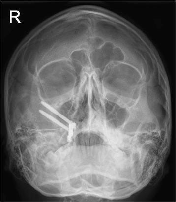 Fig. 11. Facial radiograph at 22-month follow-up