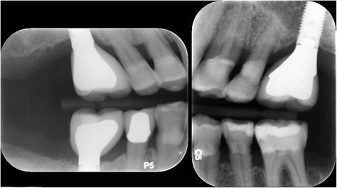 Fig. 11. Implant restoration. Implants were restored by dental students supervised by prosthodontists at the Dental Center