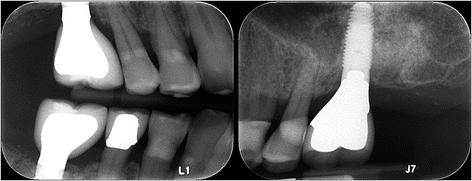 Fig. 12. Radiographic bone levels three years after placement. Bone levels remain unchanged during long-term follow-up