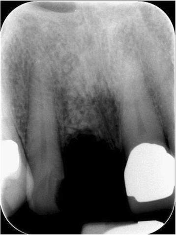 Fig. 14. Single tooth X-ray immediately after the augmentation using autogenous dentin
