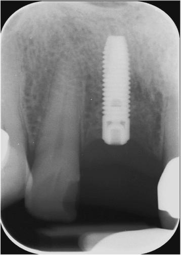 Fig. 15. Single tooth X-ray, showing a constant bone level 7 months after implant placement
