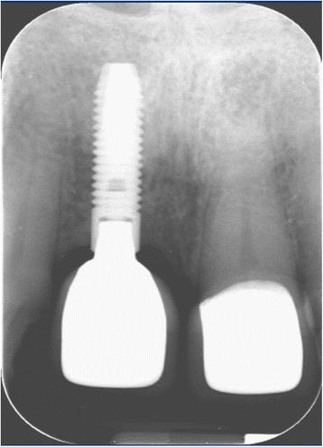 Fig. 16. Single tooth X-ray, 1 year post-implantation, showing the finalized crown