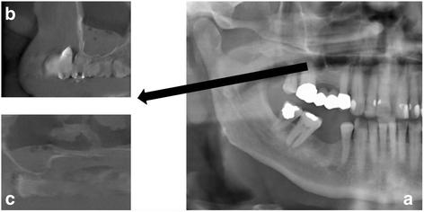 Fig. 1. rest (maxillary sinus) and b, c examples of corresponding images in cone beam computed tomography