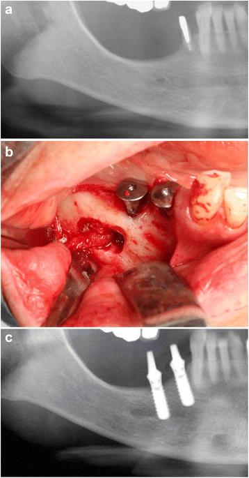 Fig. 1. Alveolar nerve repositioning in a partially edentulous mandible. a Preoperative radiograph. b The inferior alveolar nerve was transposed from the mental foramen. c Postoperative radiograph after implant insertion