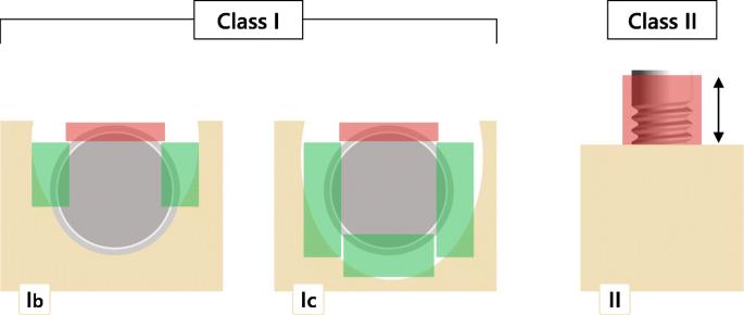 Fig. 1. Combined surgical therapy of peri-implantitis at respective defect sites: class I: intrabony component showing either a buccal dehiscency with a semicircular component (Ib) or a buccal dehiscency with a cicumferential component (Ic). Class II: supracrestal component. The red rectangles indicate the surface areas undergoing an implantoplasty, while the green areas indicate the defect areas undergoing augmentative therapy