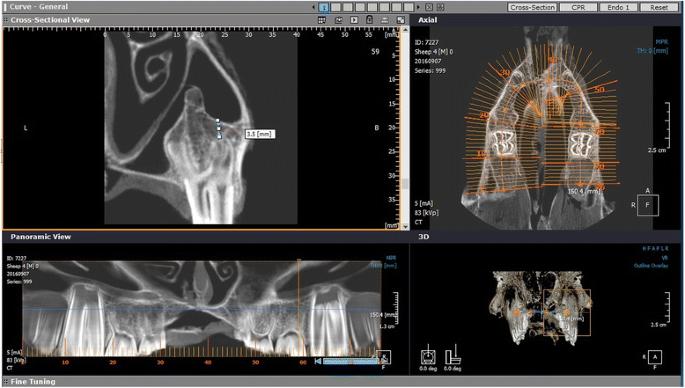 Fig. 1. Determination of the remaining bone height (RBH) on the CBCT image