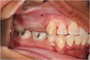 Fig. 1. Edentulous site with supra-eruption of opposing dentition