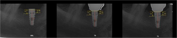 Fig. 1. Example of the location of a non-submerged implant, bone, and adjacent tooth