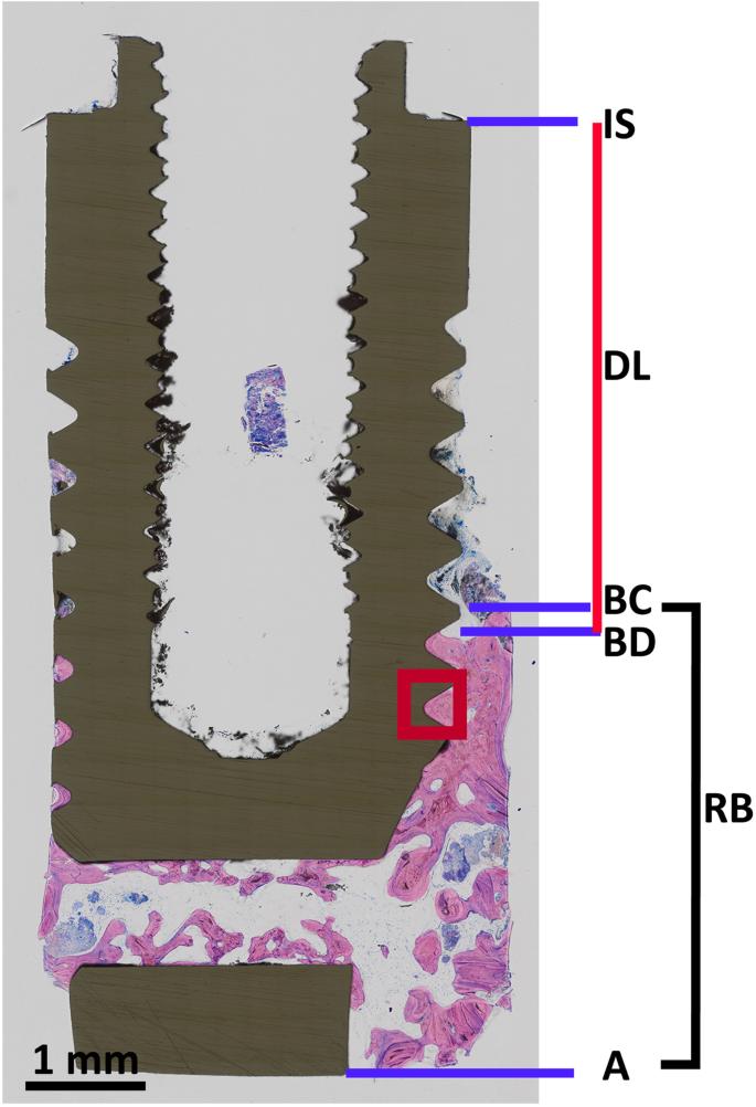 Fig. 1. Histological section illustrating the landmarks to determine the conducted histomorphometrical length measurements: DL, RB, and BIC at buccal RB. The red square frames the intra-thread area (ROI) for OD and ELD analysis