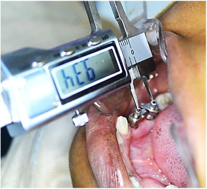 Fig. 1. Horizontal measurements between the two impression copings in the patient’s mouth
