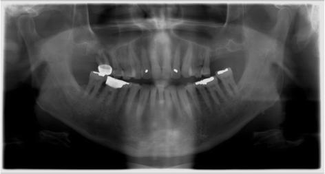 Fig. 1. Initial presentation. Panoramic radiograph taken at initial visit shows severe bone loss, supraerupted molars and furcation involvement