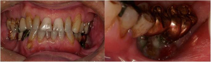 Fig. 1. Intraoral photo at the first visit