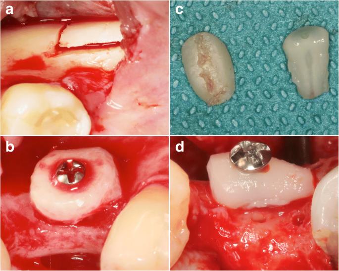 Fig. 1. Lateral ridge augmentation—a surgical procedure in the AB and TR groups. a The retromolar area served as a donor site for the harvesting of monocortical bone blocks in the AB group. b AB blocks were shaped to match the size and configuration of the defect site and fixed using one central osteosynthesis screw. c TR grafts were separated from either partially/fully retained or impacted wisdom teeth. d The most suitable specimen was positioned and fixed in a way that the exposed dentin faced the defect area, thus facilitating ankylosis at the recipient site. The crestal perforations were derived from initial attempts to pre-drill the osteosynthesis screw. All sites were left to heal in a submerged position without providing any contour augmentation procedures