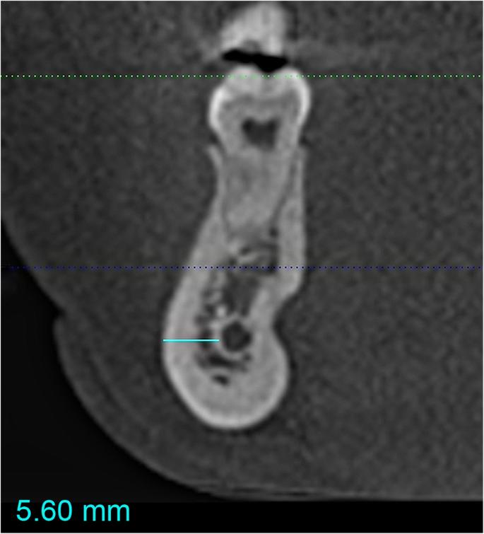 Fig. 1. Measurement of mandibular bone thickness, defined as the distance between the lateral wall of the mandibular canal and the lateral mandibular compact bone (solid turquoise line)