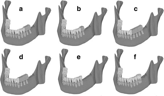 Fig. 1. Three-dimensional finite element model. The tooth roots and implant bodies are displayed with permeability. a Im67, b Im6, c Im4567, d Im456, e MT67, and f MT7
