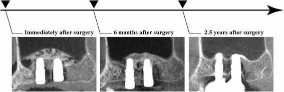 Fig. 1. Treatment protocol for the present study. Postoperative CBCT was performed a minimum of three times, i.e., immediately, 6 months, and 2.5 years after implant placement
