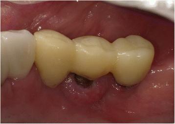 Fig. 1. Well-circumscribed gingival swelling on the lingual side of the right side of the mandible