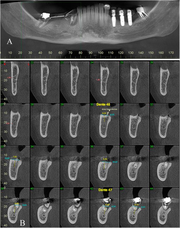 Fig. 2. a, b Tomographic findings: lesions, measurements, and bone quality