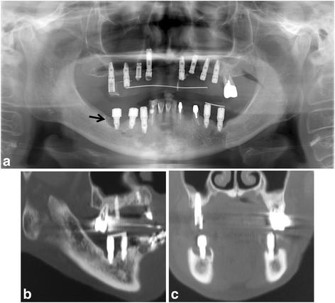 Fig. 2. Fig. 2. a Panoramic radiograph showing marked alveolar bone resorption surrounding the dental implant replacing the right mandibular first molar (arrow). b Sagittal CT view. c Coronal CT view