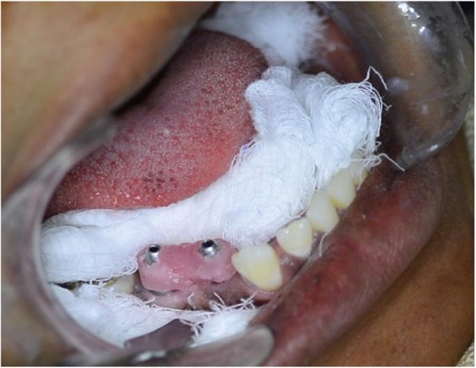 Fig. 2. Light cure acrylic resin verification jig in the patient’s mouth