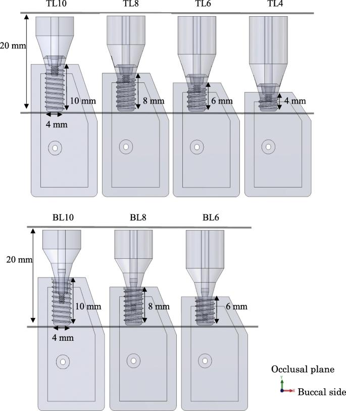 Fig. 2. Models of different implant body lengths