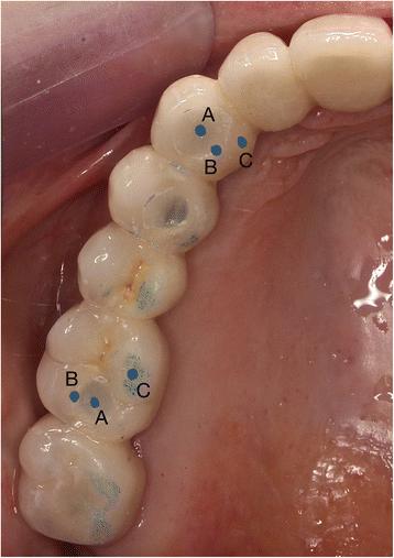 Fig. 2. Occlusal contact point