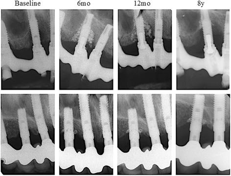 Fig. 2. PTG observed in radiographs at the 8-year follow-up