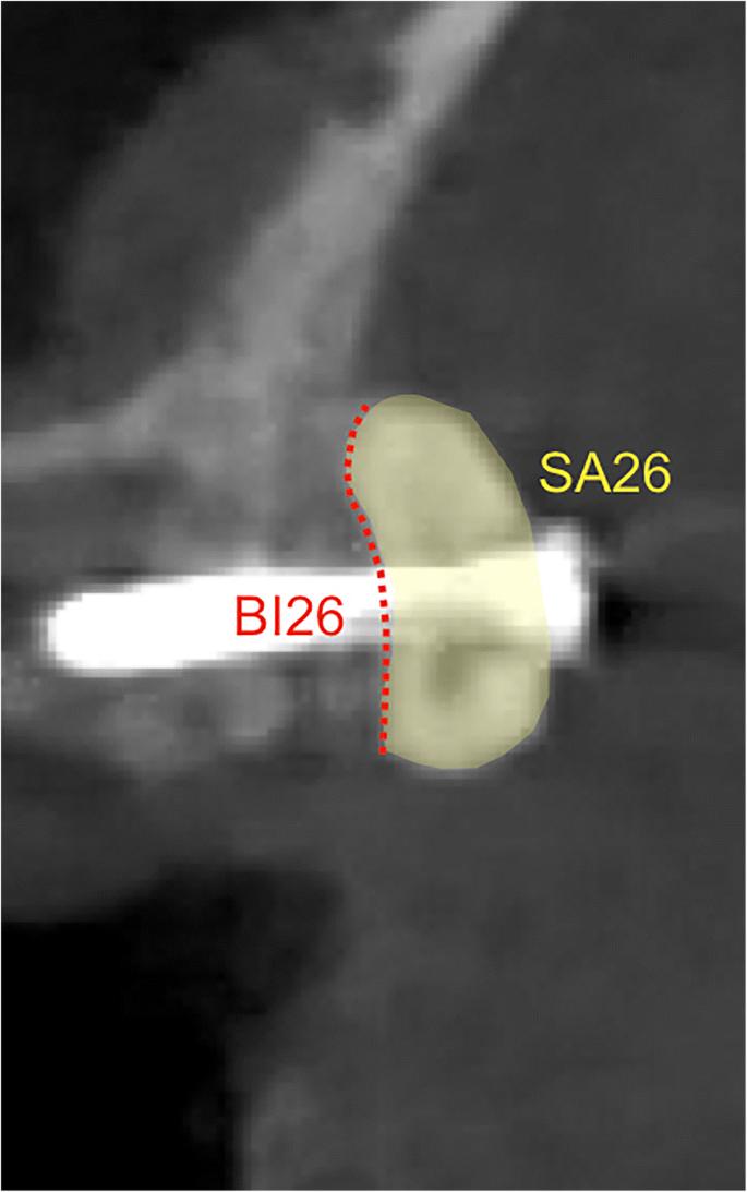 Fig. 2. Radiographic assessments. Images of the coronal planes representing the most central aspect of the respective defect sites were analyzed for the basal graft integration (i.e., contact between the graft and the host bone in %) (BI26) and the cross-sectional grafted area (mm2) (SA26)