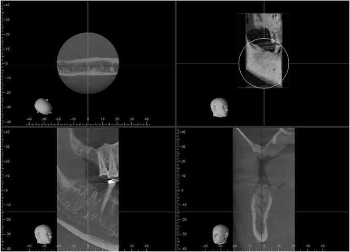 Fig. 2. Right sinus prior to first sinus grafting procedure. Cone beam CT imaging shows very little residual bone volume at implant site for the no. 3 area