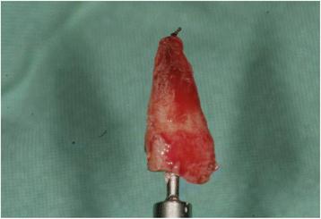 Fig. 2. The remaining root of tooth 11